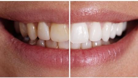 Antes y después de usar la pasta dental Bioniq® White Filler